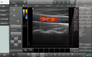 Stoßwelle mit Ultraschall, STORZ MEDICAL